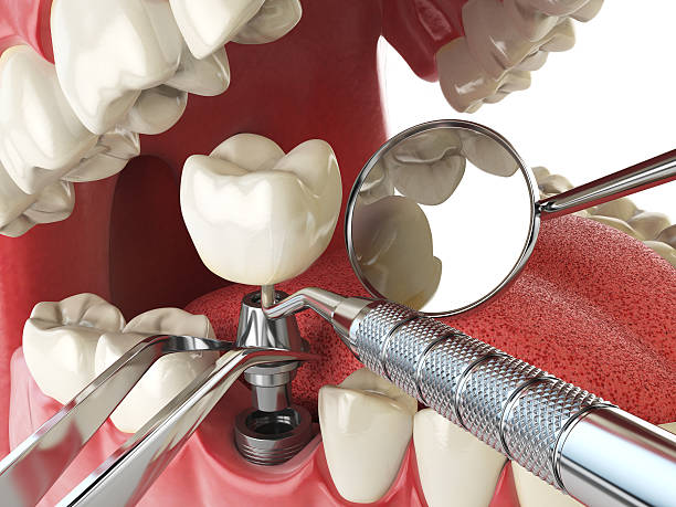 Best Dental Abscess Treatment in Buckhorn, CA